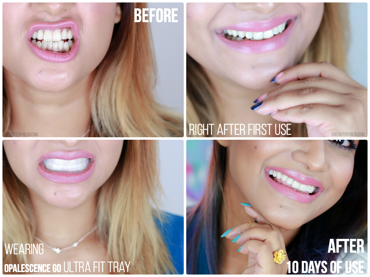 I tried Opalescence Go Teeth Whitening Kit and this is what happened...