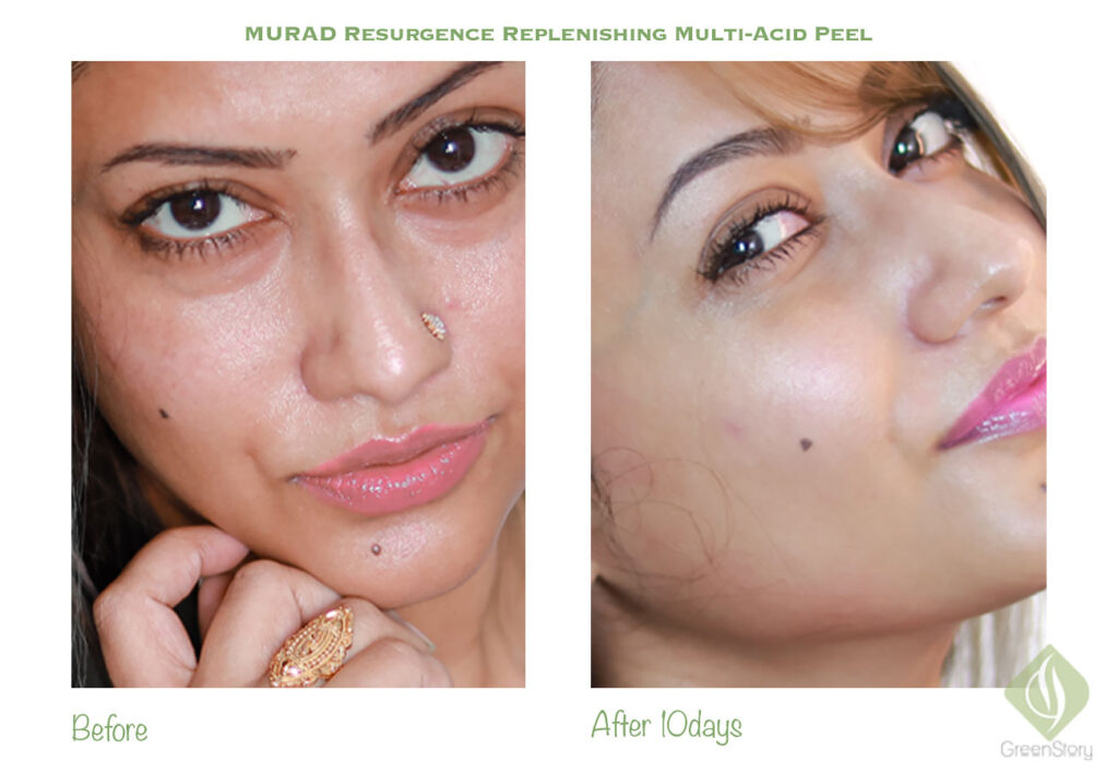 Murad Resurgence Multi Acid Peel Review with before-after picture