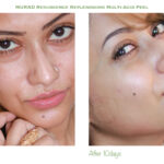 Murad-Multi-Acid-Peel-Review-Before-After-Picture