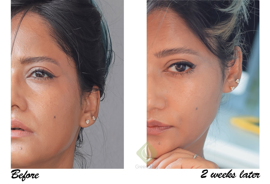 Murad Rapid Dark Spot Correcting Serum Before After Comparisn